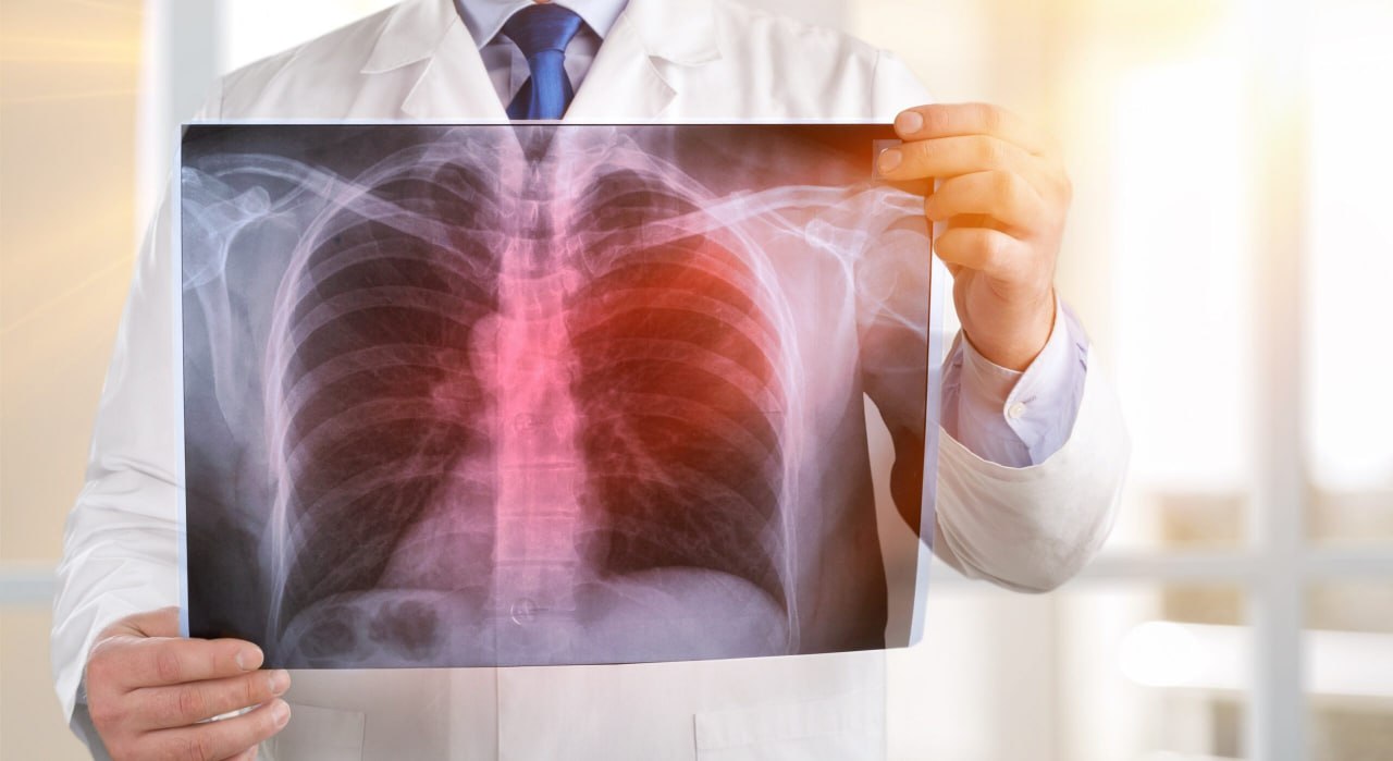 Главный внештатный пульмонолог Минздрава РК напомнила о профилактике и симптомах пневмонии
