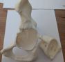 В Крыму начали выполнять операции по замене сустава с использованием индивидуального 3D-печатного импланта